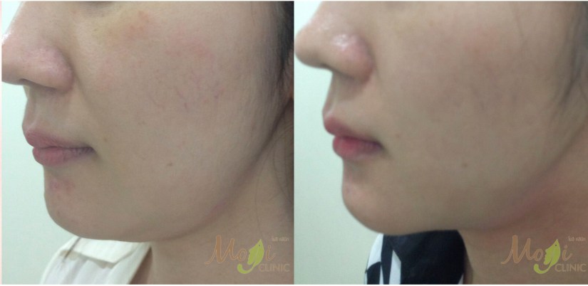 Lipo V 2 before after.jpg