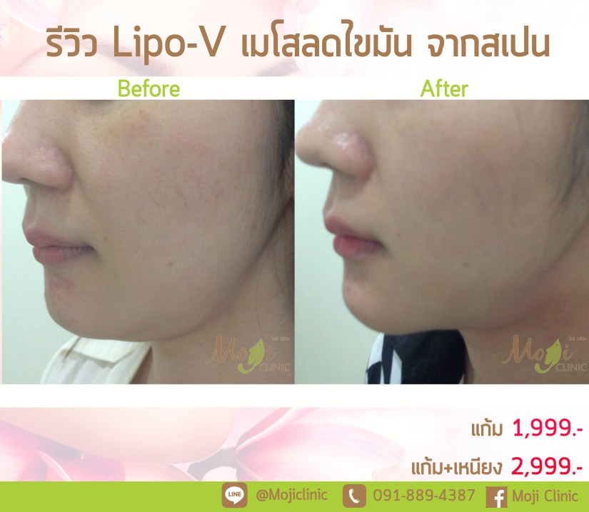 Lipo V 2 before after