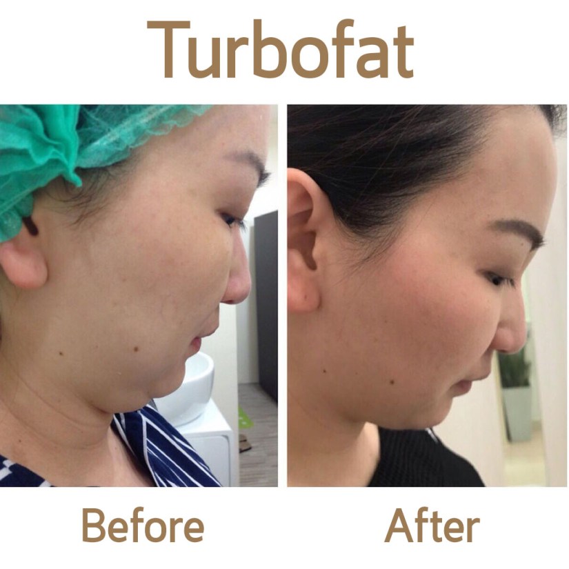 before after wow for line